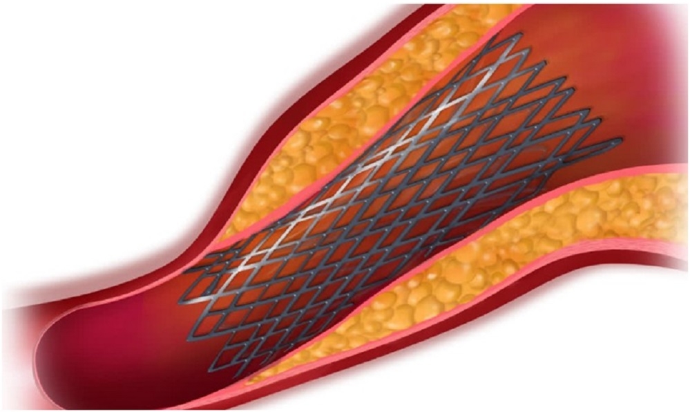 Made In India New Generation Heart Stent Receives 