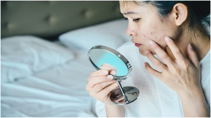 Adult Acne Is Real But There Are Ways To Treat It Heres What To Know