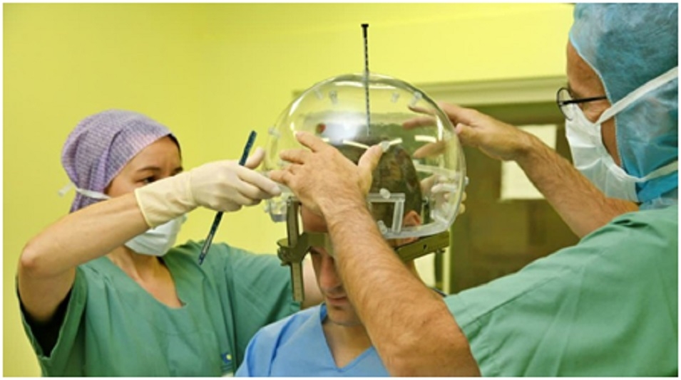 World Stroke Day 2026 All About AVMs And Brain Haemorrhage